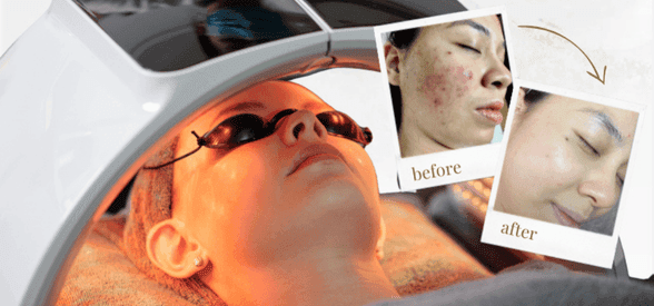 Ultimate Anti-Acne LED Facial Gift Voucher